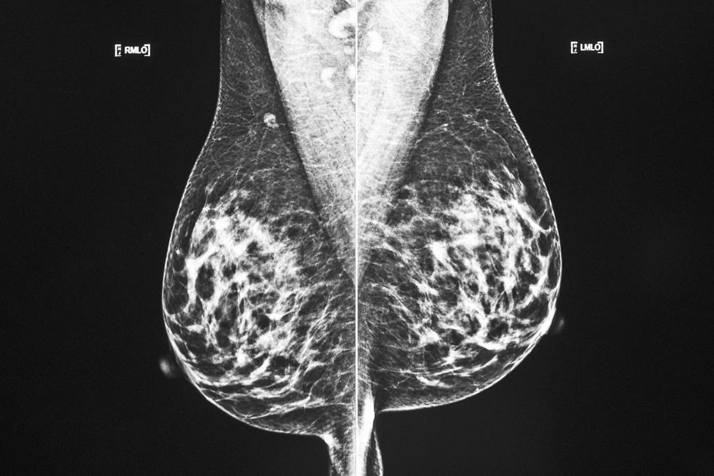Cancer du sein: survie et qualité de vie s'améliorent constamment