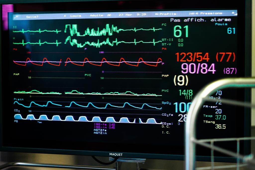 La fibrillation auriculaire pourrait avoir des causes génétiques