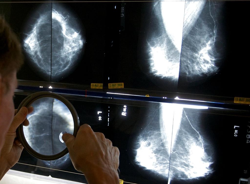 Une étude suggère un dépistage moins fréquent pour les survivantes du cancer du sein