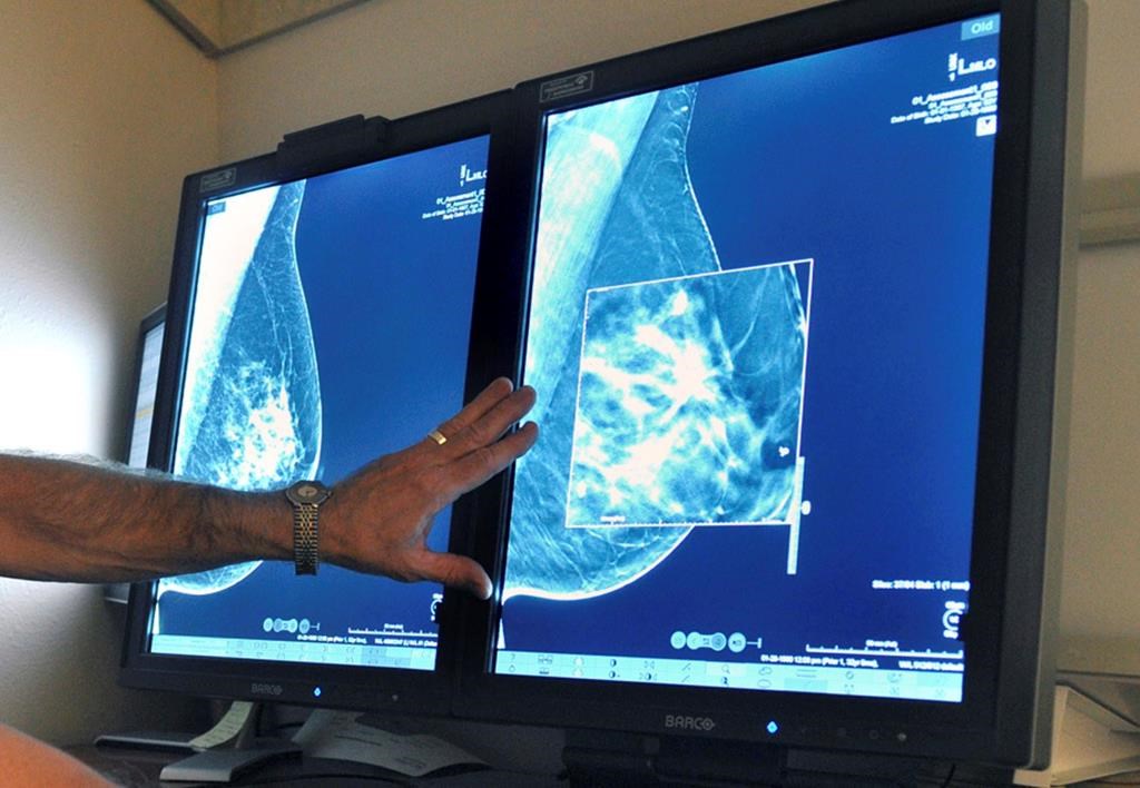 Le dépistage précoce du cancer du sein permettrait d'économiser des millions