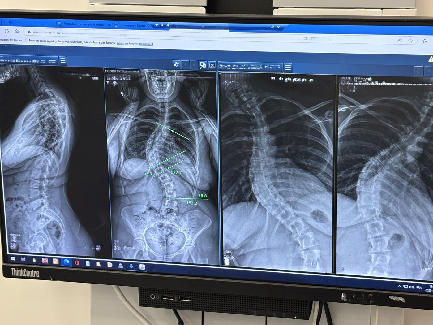 Le dépistage de la scoliose présente des lacunes au Québec